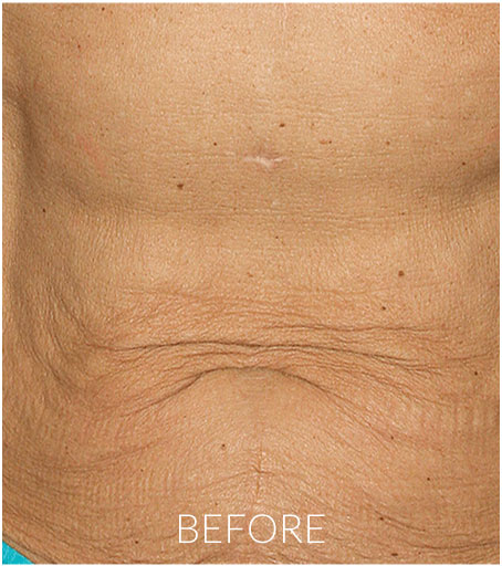 Thermage® before after